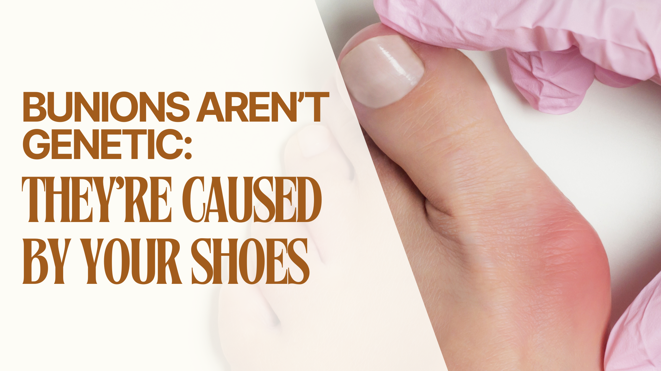 👣 Bunions Aren’t Genetic: They’re Caused by Your Shoes